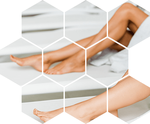 Лазерная эпиляция