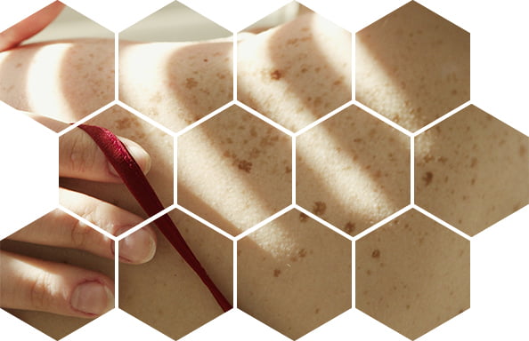 удаление новообразований