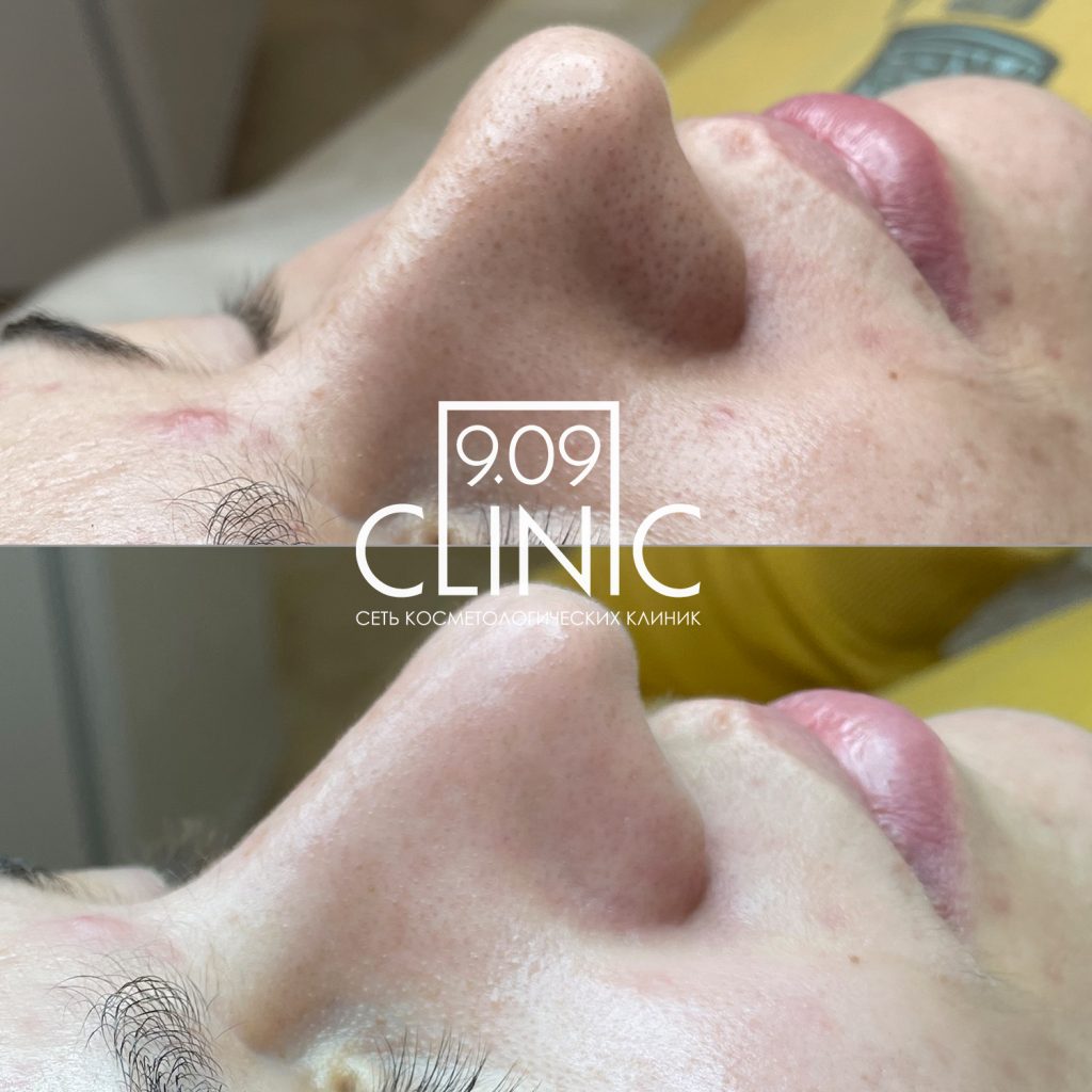 Механическая чистка кожи лица