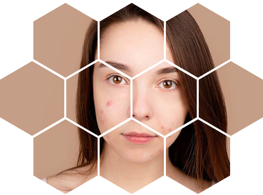 Лазерное лечение акне