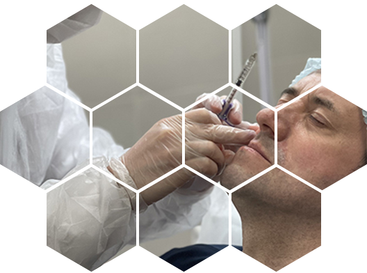 Контурная пластика носогубных складок