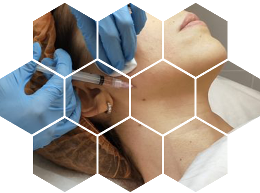 Биоревитализация