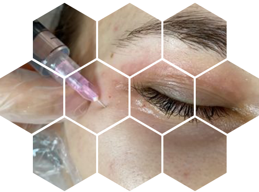 Биоревитализация