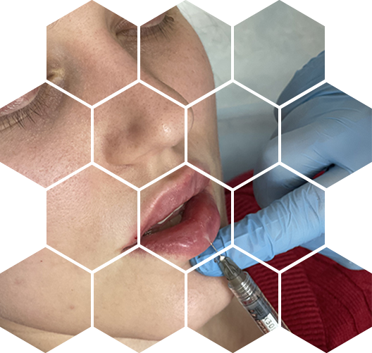 Контурная пластика губ