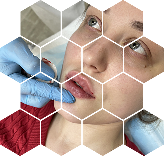 Контурная пластика губ