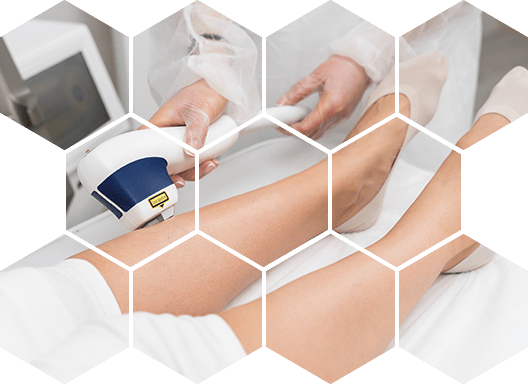 Лазерная эпиляция голеней