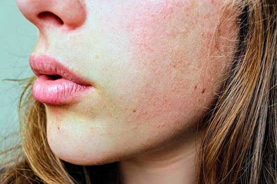 Чистка кожи лица