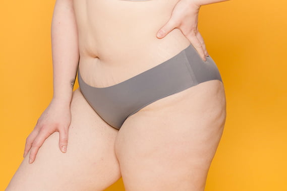 антицеллюлитный массаж