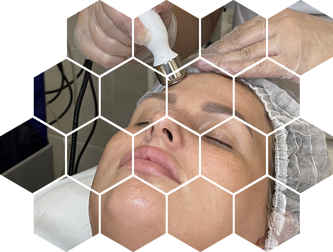 лазерный пилинг