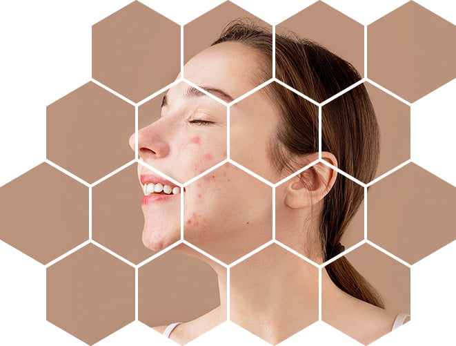 лазерное лечение акне