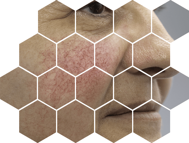 лечение купероза лазером