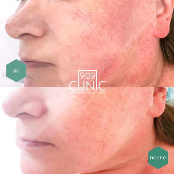 лазерное омоложение