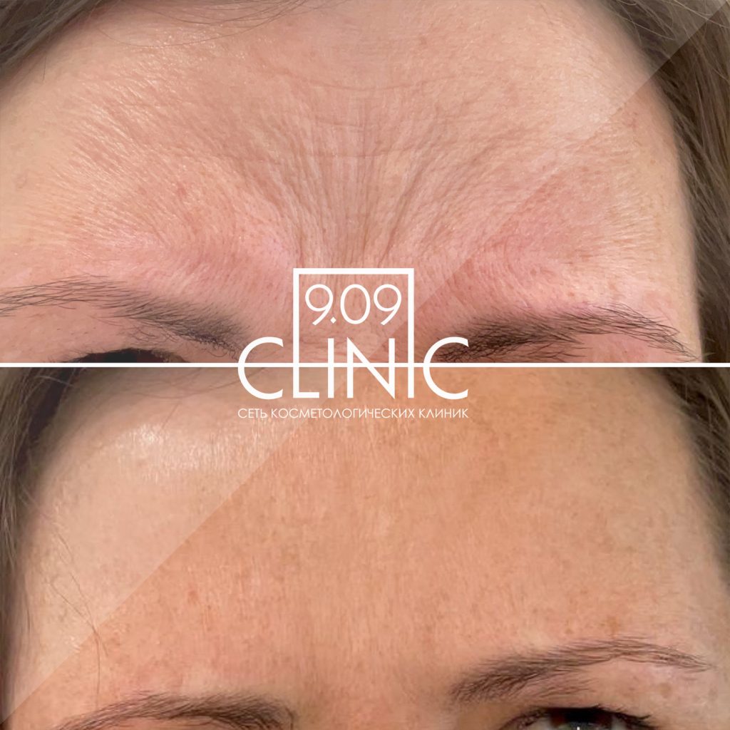 Инъекции препарата Диспорт