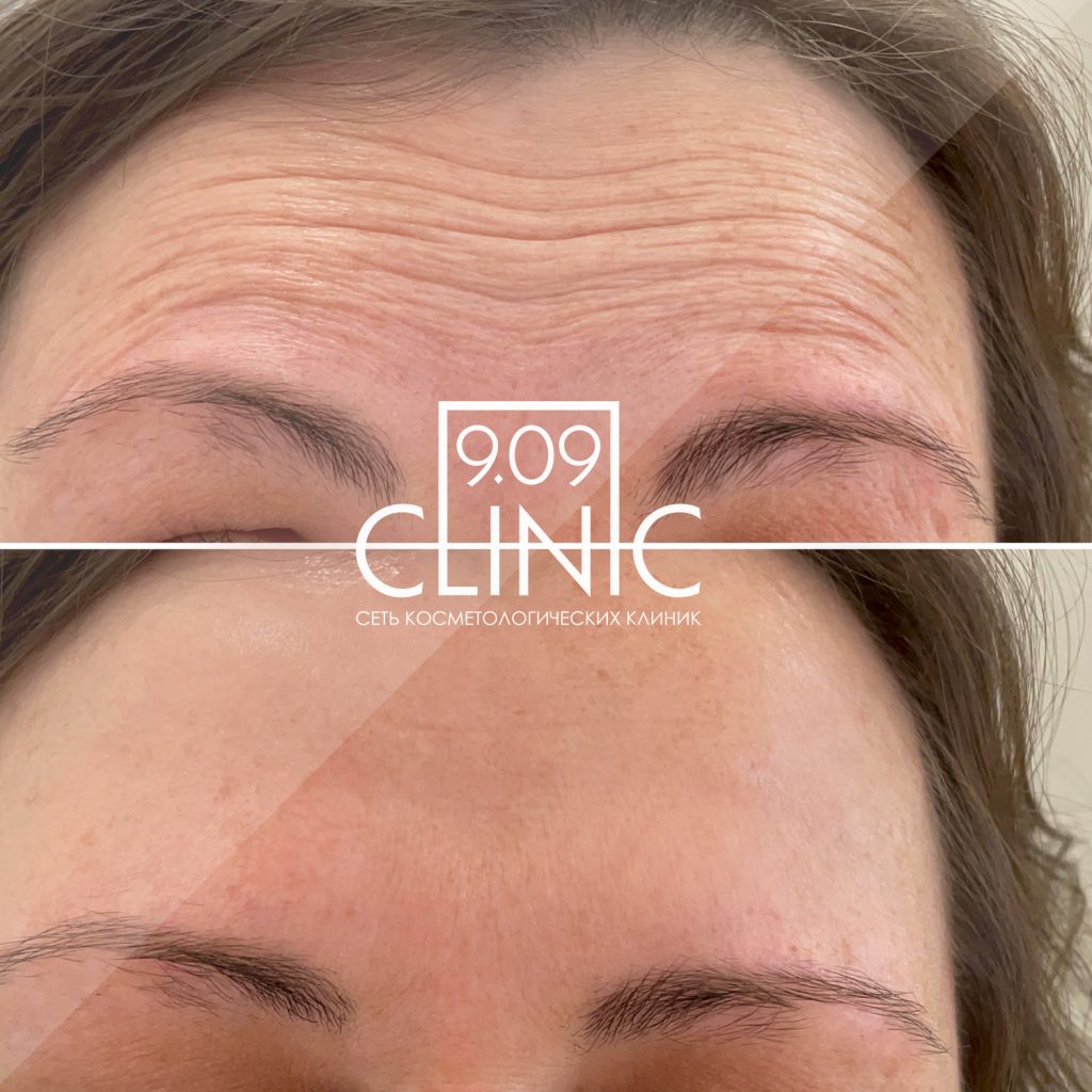 Инъекции препарата Диспорт